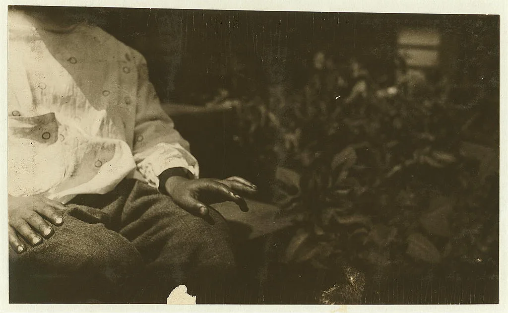 Byron's cut finger. (See also #2453, #2435.)  Location: Eastport,…, Maine, 1911