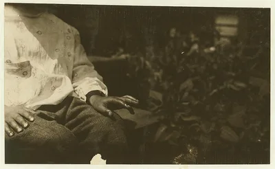 Byron's cut finger. (See also #2453, #2435.)  Location: Eastport,…, Maine, 1911