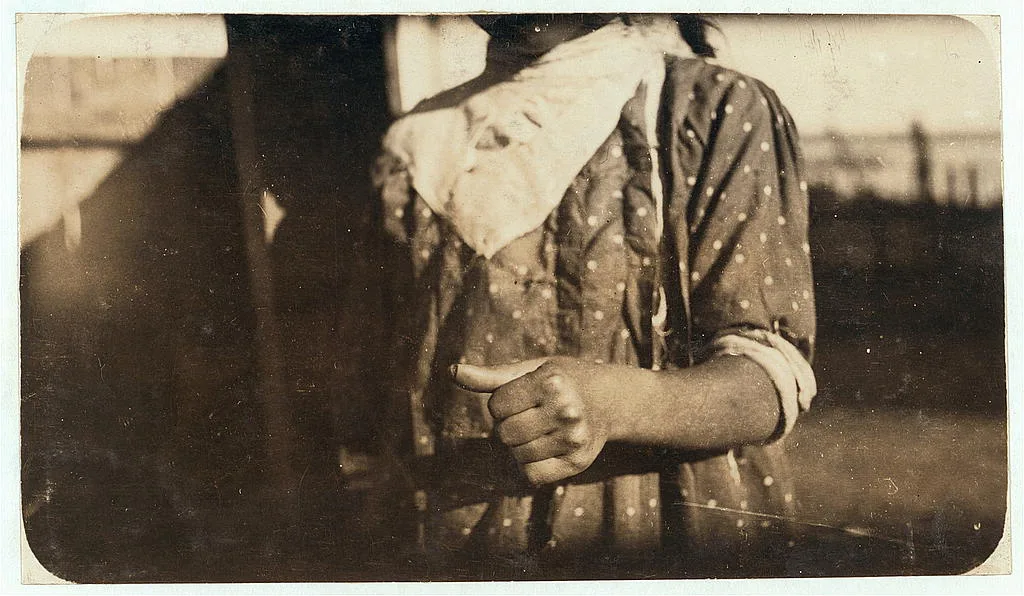 Phoebe's thumb [Phoebe Thomas], a week after the accident. She was…, Maine, 1911